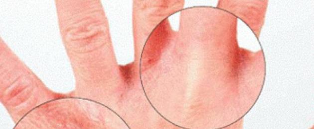 Сухость кожи рук трещины лечение народными средствами. Почему трескается кожа на руках? Причины сухости кожи рук и ног